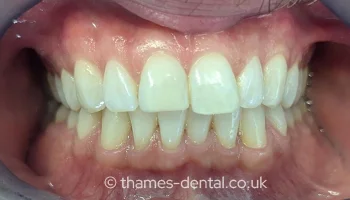 Composite bonding case at Thames Street Dental, after treatment