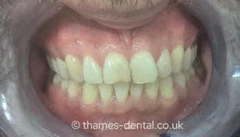 Composite bonding case at Thames Street Dental, before treatment