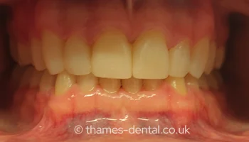 Invisalign and composite bonding case at Thames Street Dental, after treatment