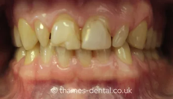 Invisalign and composite bonding case at Thames Street Dental, before treatment