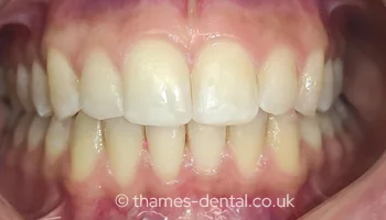 Invisalign case at Thames Street Dental, after treatment