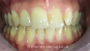 Invisalign case at Thames Street Dental, before treatment