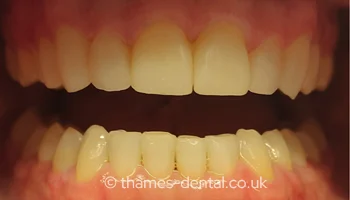Invisalign and teeth whitening case at Thames Street Dental, after treatment