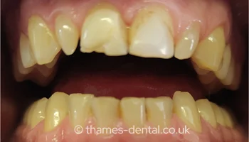 Invisalign and teeth whitening case at Thames Street Dental, before treatment